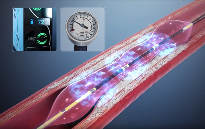 UT Health East Texas Heart and Vascular Institute Offers First-of-Its-Kind Treatment for Heart Disease